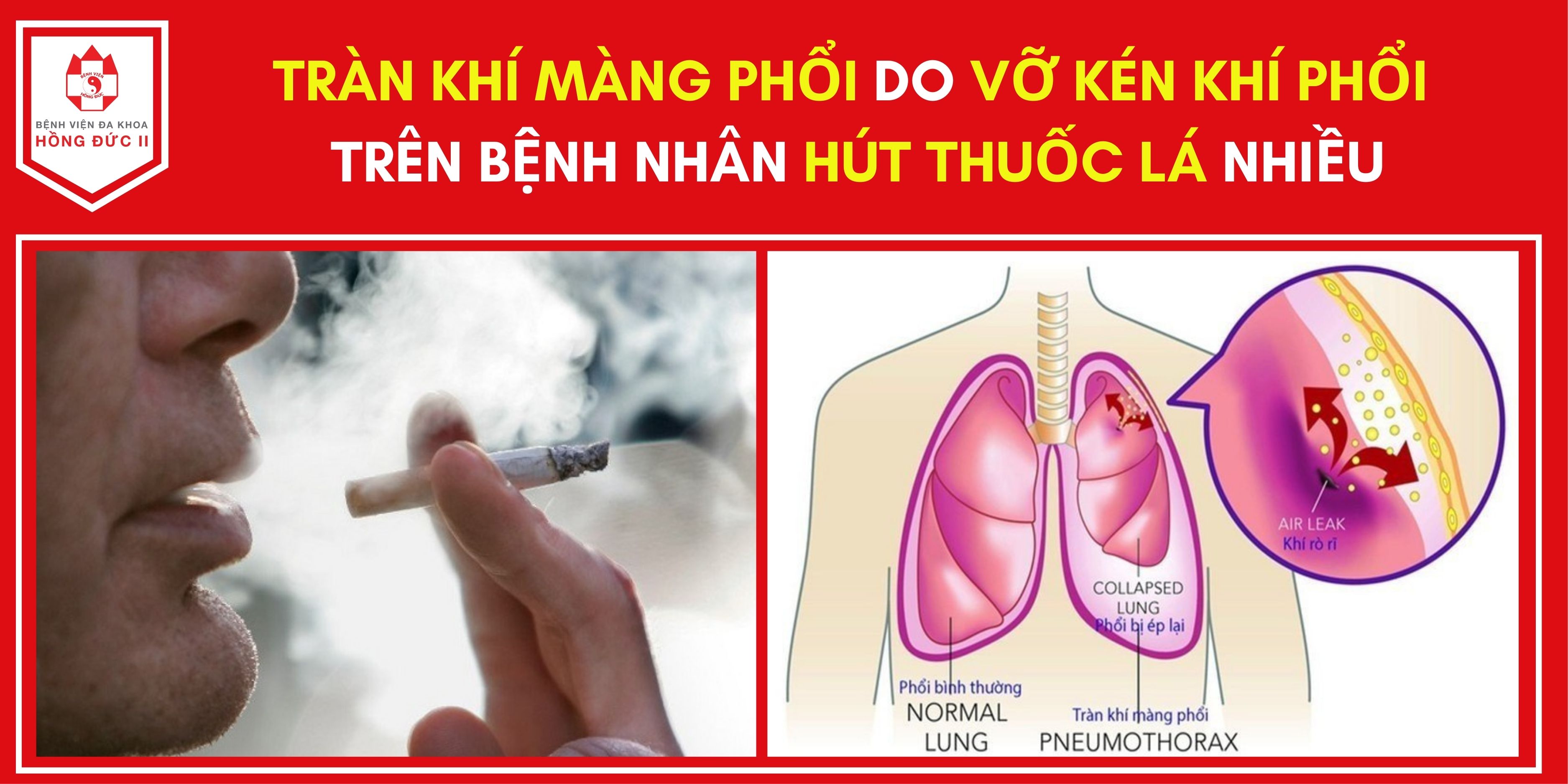 Tràn khí màng phồi do vỡ kén khi phổi trên bệnh nhân hút thuốc lá nhiều